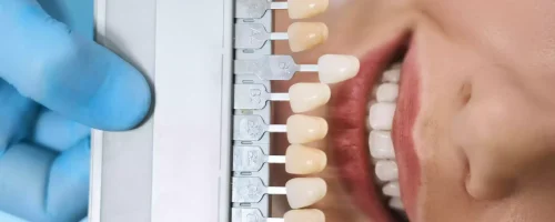 top-view-of-dentist-with-veneers